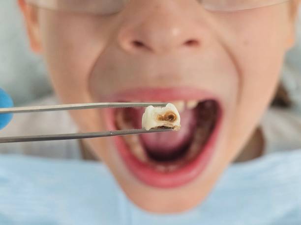 Best Emergency Tooth Extraction in Norco, CA