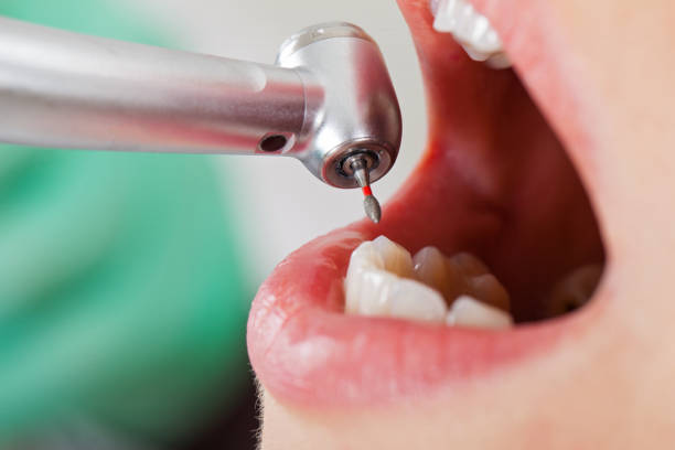 Best Emergency Wisdom Teeth Removal in Norco, CA